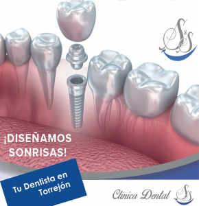 Implantes dentales Clínica Dental S&S